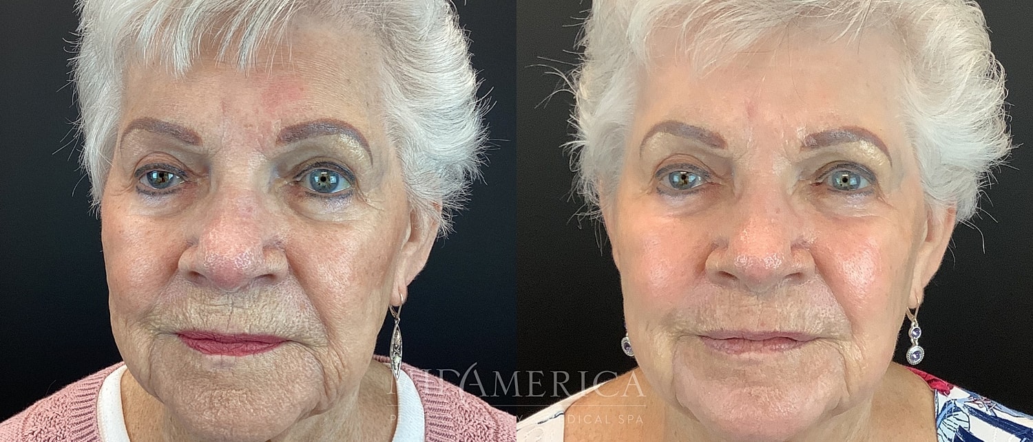 Skin Resurfacing Before & After