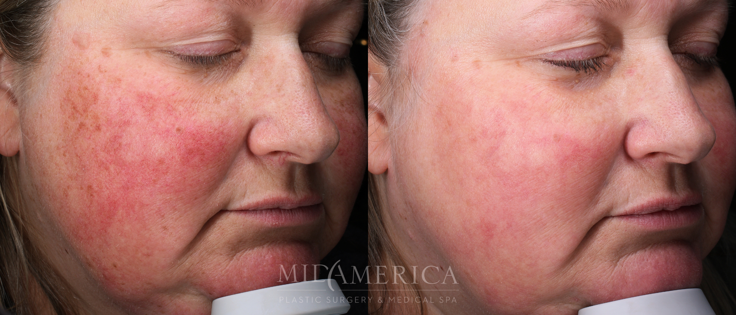 Laser Services Before & After