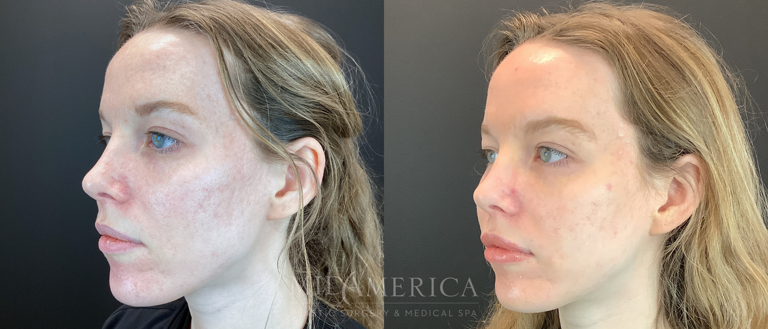 Laser Services Before & After
