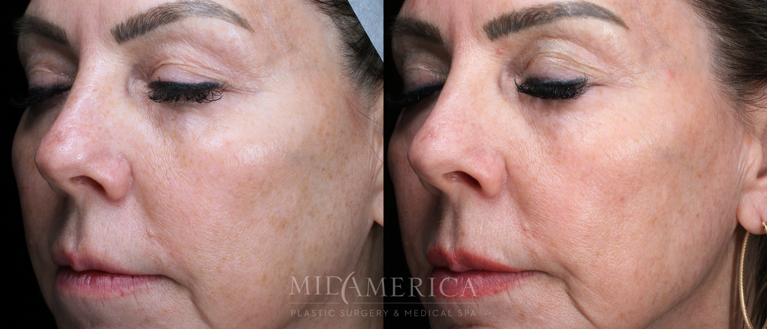 Laser Services Before & After