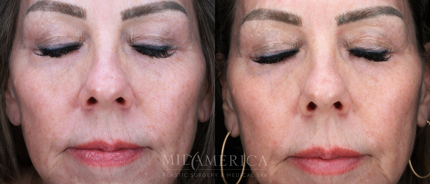 Laser Services Before & After