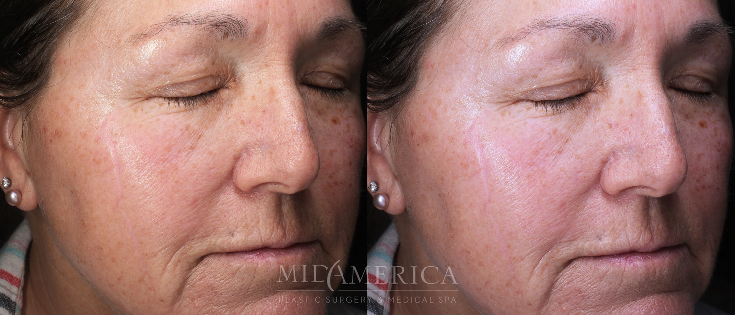 Laser Services Before & After