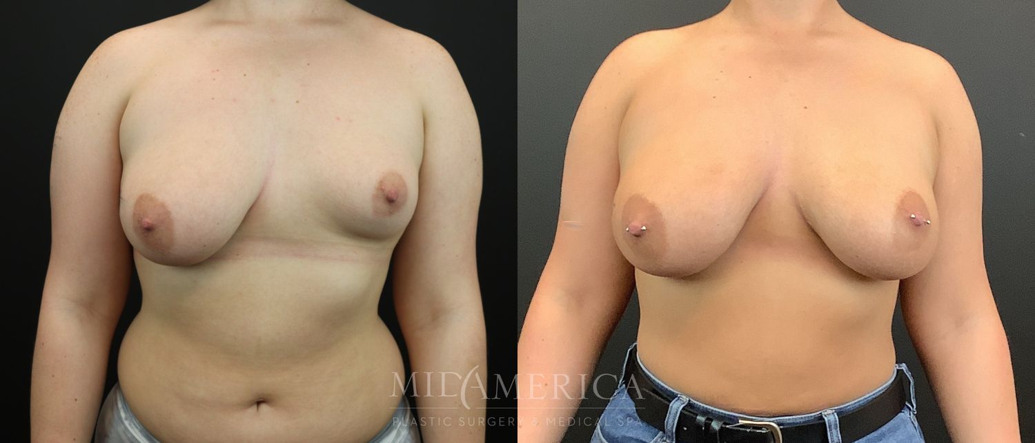Fat Grafting Before & After