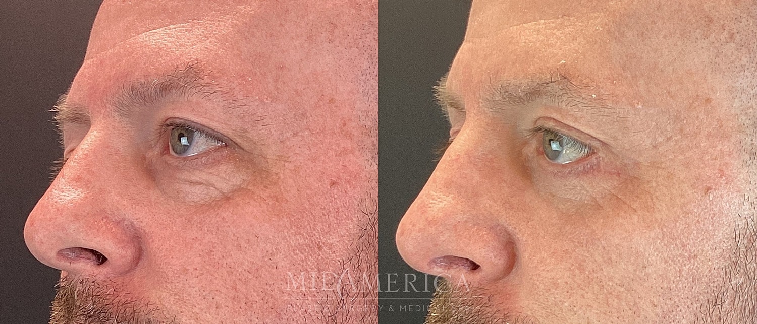 Lower Eyelid Surgery Before & After