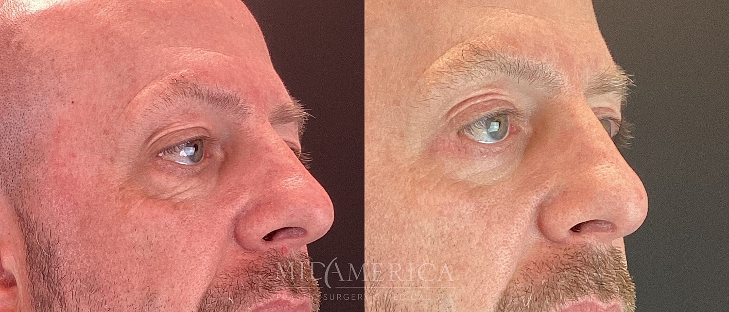 Lower Eyelid Surgery Before & After