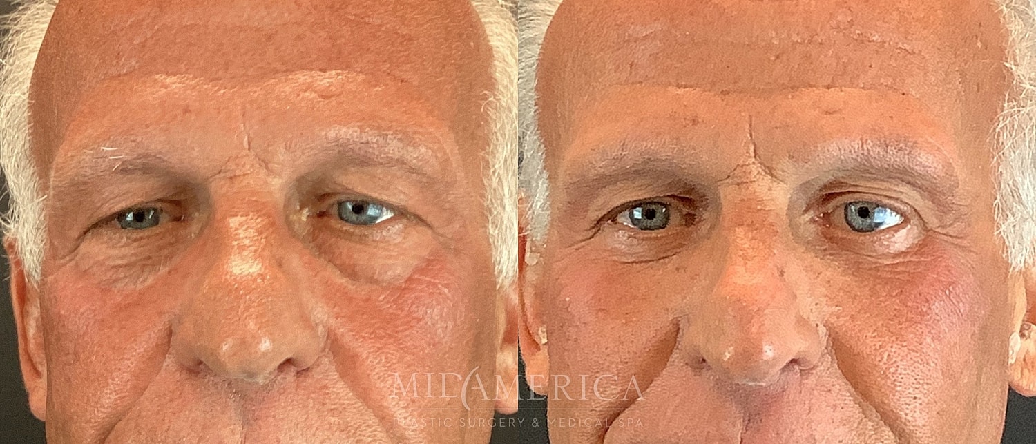 Lower Eyelid Surgery Before & After