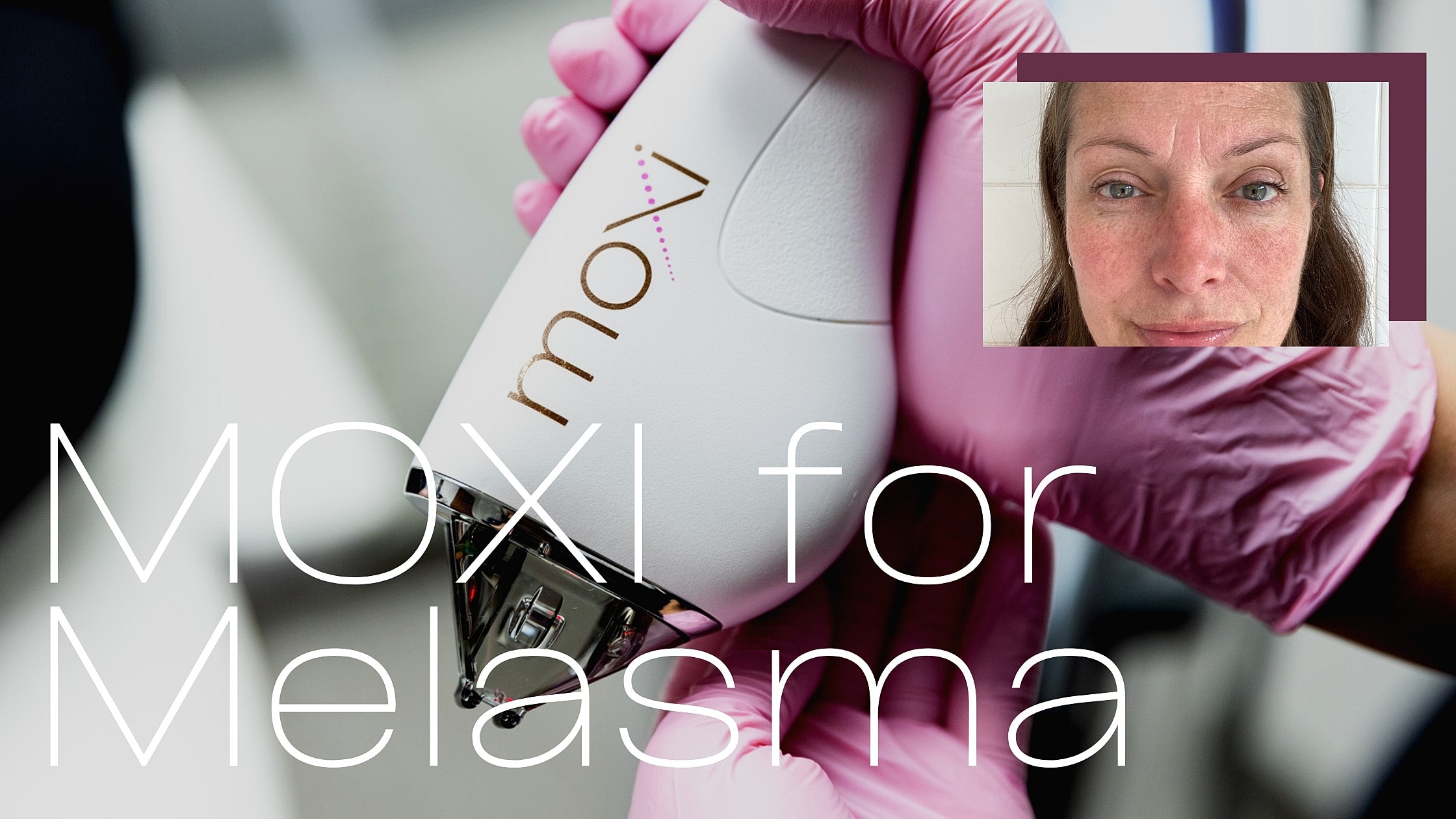 Moxi device for treating melasma skin condition.